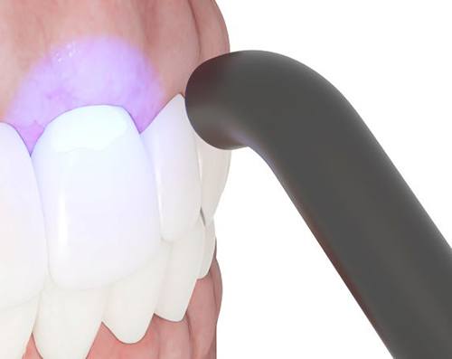 Illustration of curing light being used to harden dental bonding