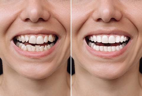 Before and after veneers