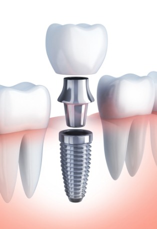 Animated smile showing parts of dental implants