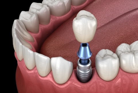 Animated smile during dental implant supported dental crown placement