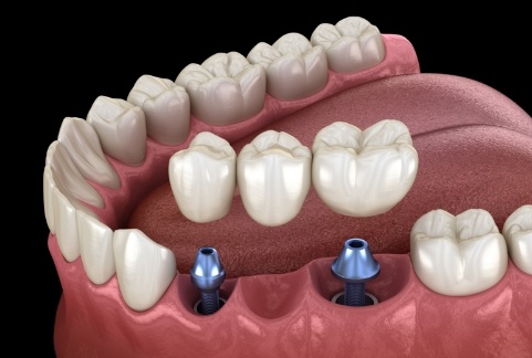 Animated smile during dental implant supported fixed bridge placement