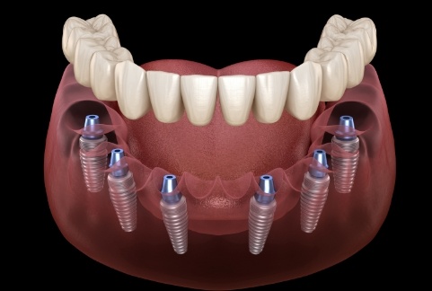 Animated smile during dental implant supported denture placement