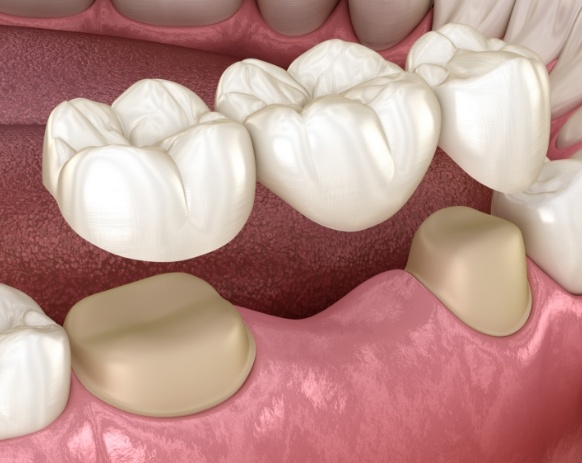 Animated smile during dental bridge placement