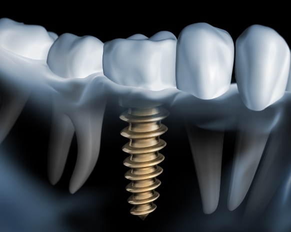 Animated smile with dental implant supported dental crown