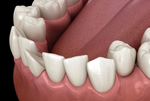 a 3 D example of crooked teeth