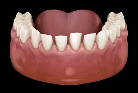 a 3 D illustration of gapped teeth