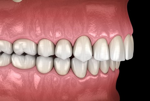 a 3 D illustration of an overbite