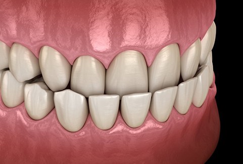 a 3 D example of an underbite