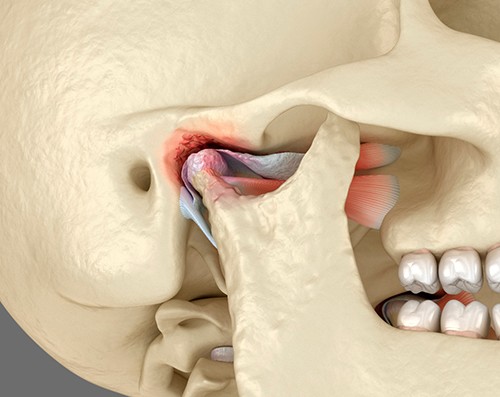 A model of a jaw with TMJ disorder