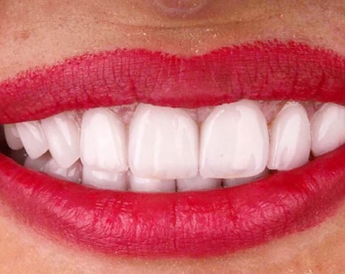 Before and after veneers in Lancaster