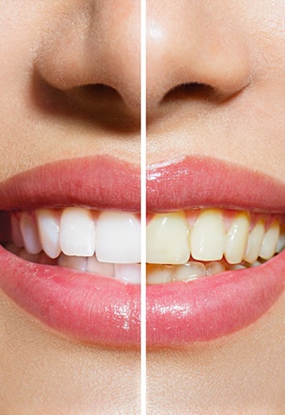 Woman’s smile before and after teeth whitening in Lancaster