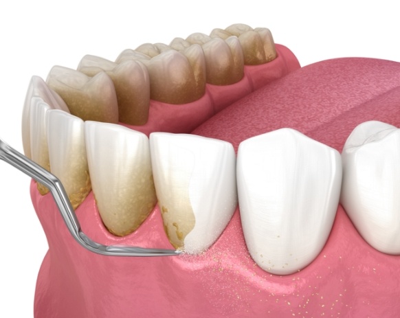 Animated smile during scaling and root planing